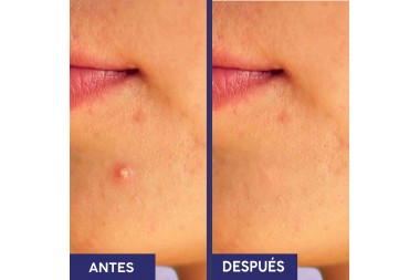 Oxy 10 En Gel Caja Con Frasco Con 30 G – Elimina El Ancé